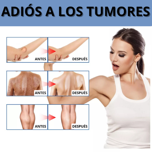 Lipoma Reducer – Spray Natural X2